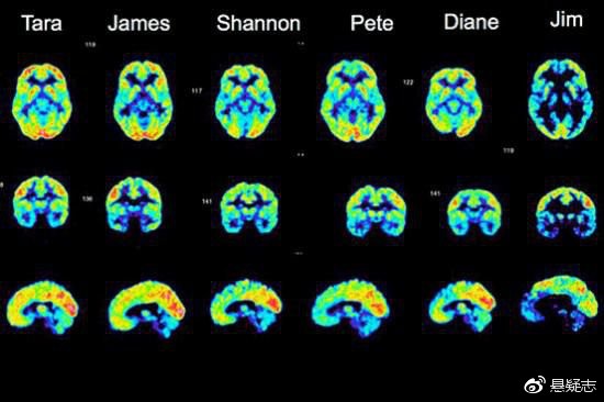 法伦熏陶家属的脑扫描图，最右边的是熏陶本人的（Jim ) ，跟杀人犯相像的脑扫描