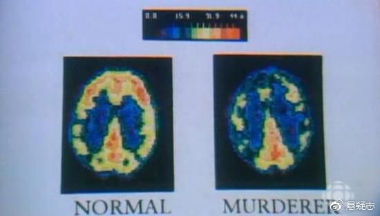 法伦的大脑PET扫描